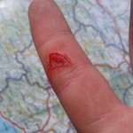 Wassdruckpistolenverletzung